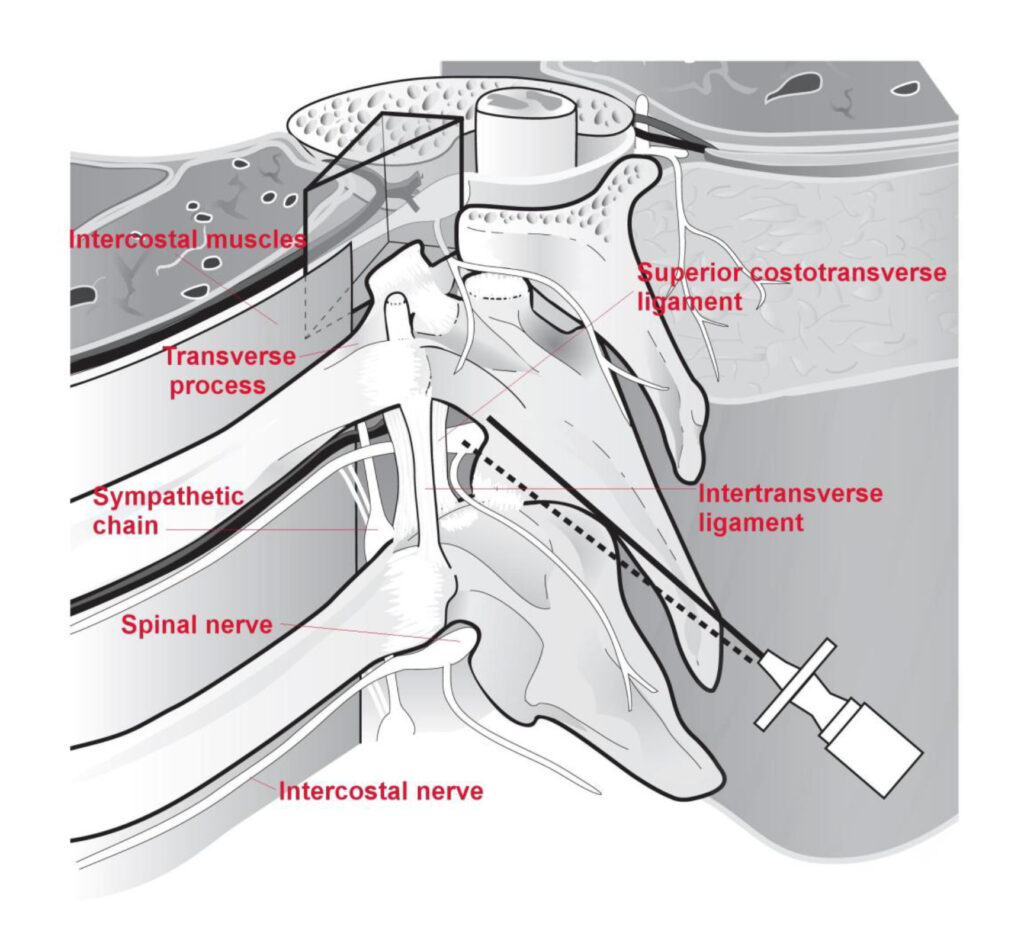 Benefits of using pvb thoracic single injection site w/img gid for pain management